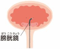 膀胱鏡（ぼうこうきょう）　図版