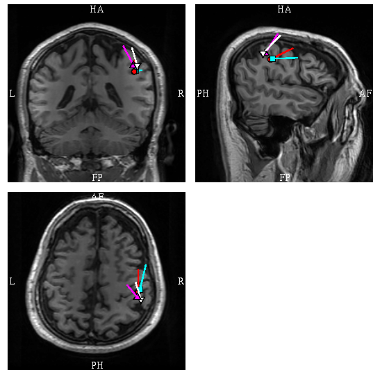脳磁計MEG（magnetoencephalogram） 写真3