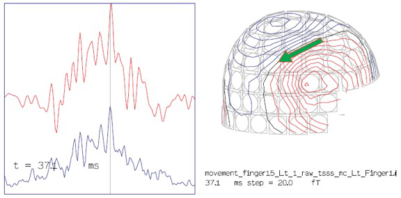 Motor correlogram left 1st finger movement 写真1