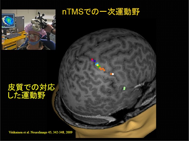 経頭蓋磁気刺激（nTMS） 写真1