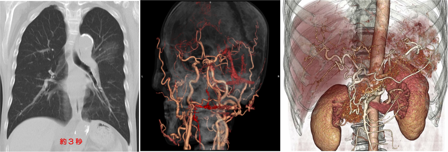 CT検査結果　画像
