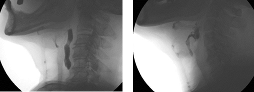 嚥下造影検査結果　画像